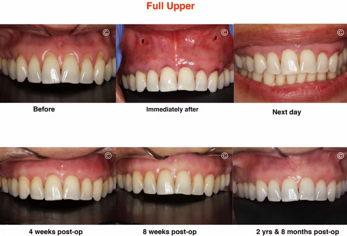Before and After Gum Recession Surgery 1