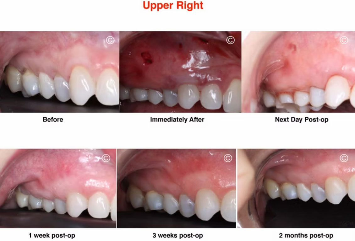 Before and After Gum Recession Surgery 2