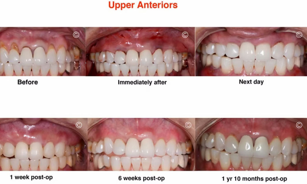 Before and After Gum Recession Surgery 3