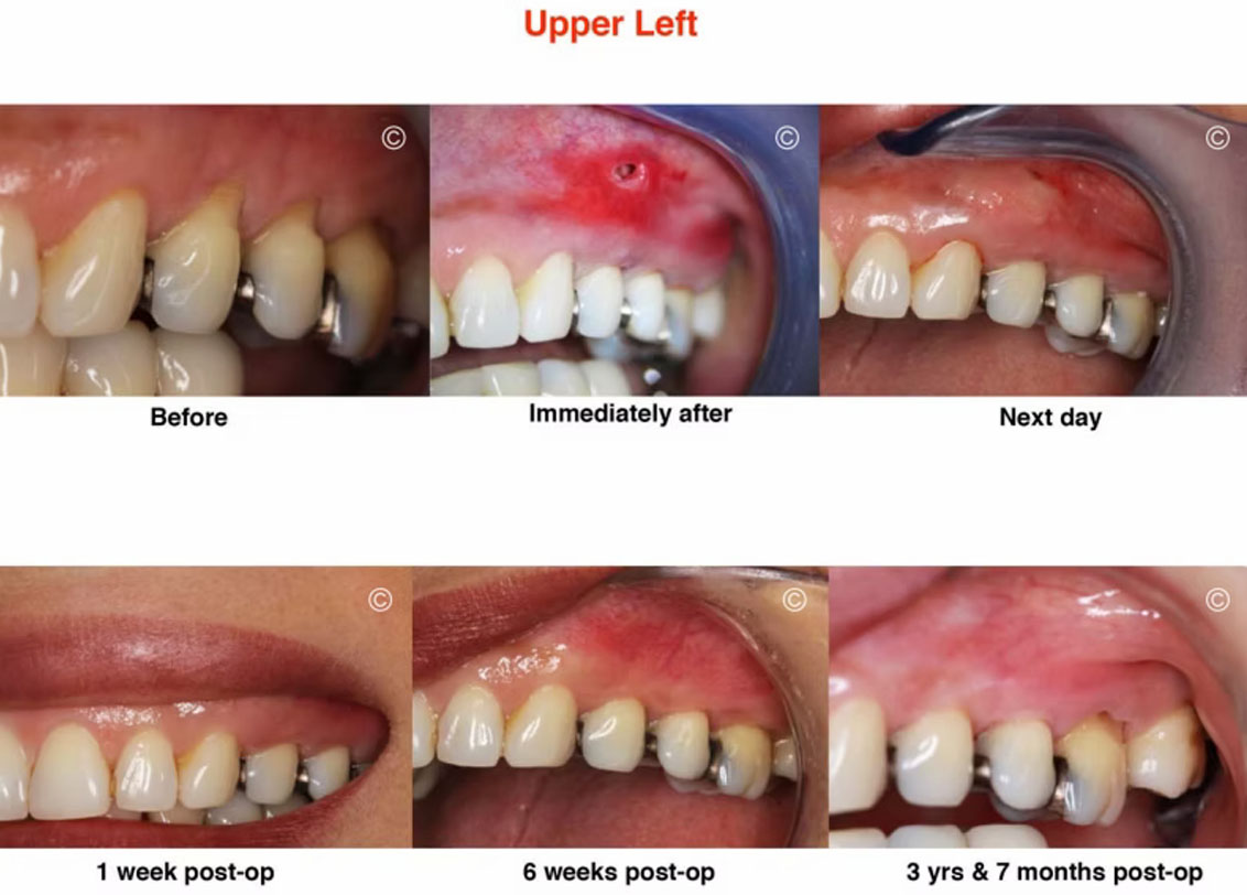 Before and After Gum Recession Surgery 4
