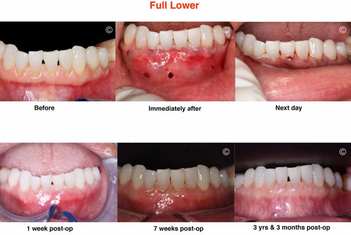 Before and After Gum Recession Surgery 5
